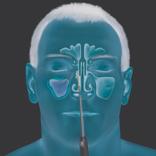 Sinus Dilation Devices Are Useful For Opening Up The Blocked Sinus Passages During Surgeries And They Enable Airflow And Adequate Drainage